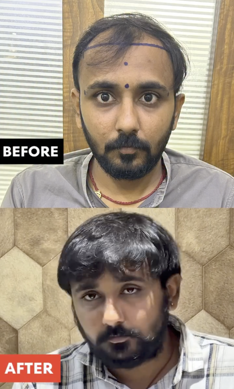 Hair Transplant Before and After Result 3